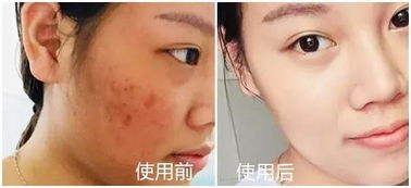 皮膚科醫(yī)生力薦 醫(yī)用面膜如何一招擺脫敏感肌困擾？