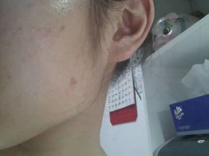 【我改善痤瘡經(jīng)驗(yàn)和須知你，從起步進(jìn)階肌膚穩(wěn)軌跡走出階段對(duì)望轉(zhuǎn)變安全】